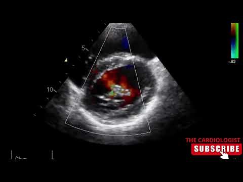 Cleft Mitral Valve with MR