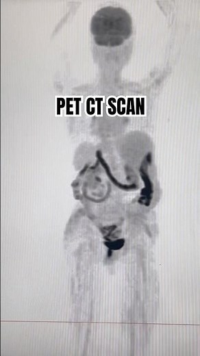 PET CT SCAN #nuclearmedicine #facts #health #science #neuroscience #theranostics #research