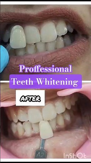 Magical Teeth Whitening #whiteteeth #teethbleaching