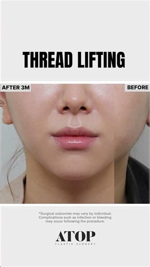 Thread Lifting at ATOP