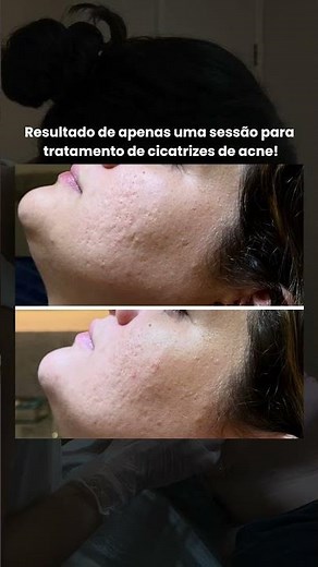 Como tratar cicatrizes de acne?