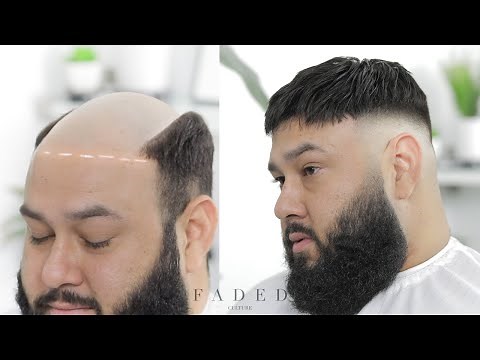 MENS WIG TUTORIAL (CRAZY HAIR LOSS TREATMENT)