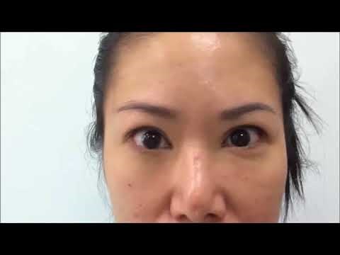 Opsoclonus in a Patient After Treatment