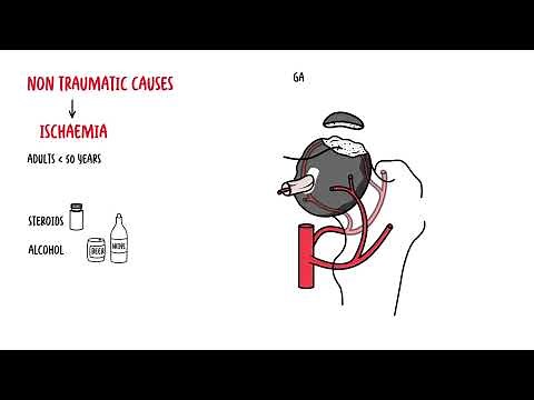 Osteonecrosis of the Hip (femoral head) - Avascular Necrosis