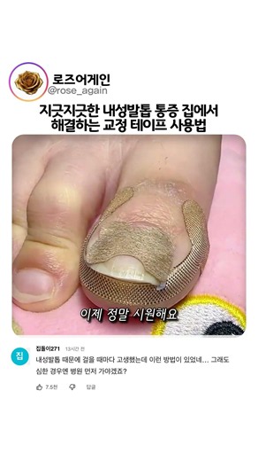 지긋지긋한 내성발톱 통증 집에서 해결하는 교정 테이프 사용법