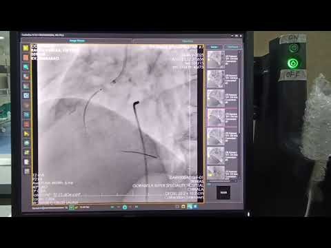 Primary ptca to RCA with Temporary Pacemaker support