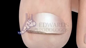 45K views · 607 reactions | San Isidro Av. Conquistadores 145 Aprovecha la promo limitada de Noviembre!  Cúrate los hongos  de las uñas, sin pastillas con tratamiento láser ⚡, 119.90 soles por sesión en paquete de 10. Desde 1968 en podología en el Perú.  Escríbenos para más información 939923457 o llámanos al -4414971, 4215551 | Edwards Podólogos & Podiatras | Facebook