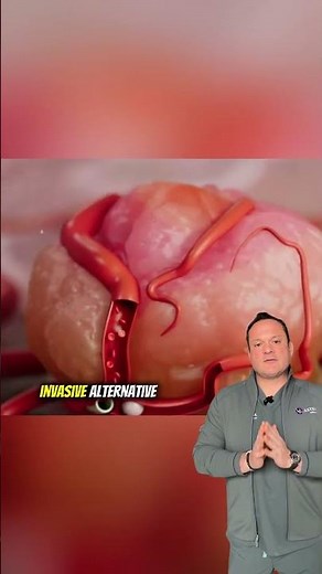 Uterine Fibroid Embolization: A Simple Solution for Fibroids!