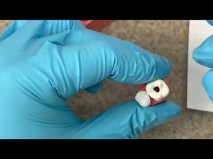 How to pass the CDCA ADEX Dental Exam Part 3 Endo/Prosth