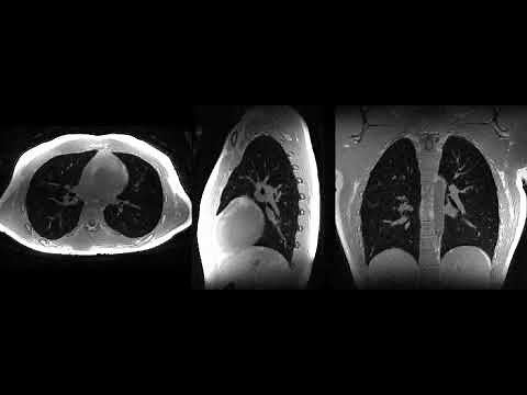 Motion-resolved High-resolution Lung MRI