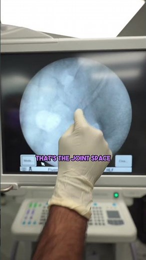 Sacroiliac Joint Injection