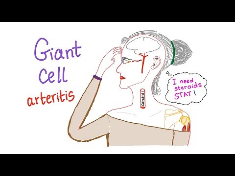 Giant cell arteritis (Temporal arteritis)