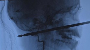 10-Year-Old Boy Takes Meat Skewer to the Face in Freak Accident — and Survives