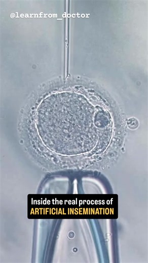 learn from doctor | Most people hear the term “artificial insemination” but have no idea how precise the procedure actually is. This short clip shows the real... | Instagram