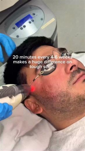 Dr. Howard Sobel | NYC Cosmetic Dermatologist on Instagram: "Elevate your skin texture and soften acne scars, without going under. ⭐️ Fraxel laser resurfacing targets damaged skin cells to stimulate collagen, smooth uneven texture, and refine the appearance of acne scars. Minimal downtime with visible, long-lasting results.⁠ ⁠ 📍 960 A Park Ave, New York, NY 10028⁠ 📞 (212) 288-0060⁠ ⁠ #SobelSkin #Fraxel #AcneScars #LaserResurfacing #SkinTexture #newyorkcity"