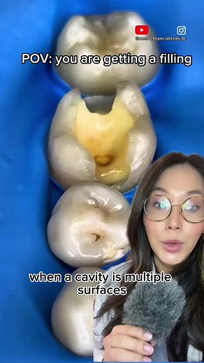 3.2K views · 16 reactions | When fixing a cavity, here’s how we keep your teeth from getting stuck together. #cavity #cavities #fillings #dentist #dentistry #dentalvideo | JoycetheDentist | Facebook