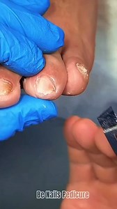 What happened to these toenail? 😨 Most dirtiest Toenail in world #unhas #glitternails #gel #nailaddict #pedicure #nailporn #fashion #makeup #unhasdecoradas #naturalnails #explore #nailpro #hair #nailsaddict #instagood #ombrenails #coffinnails #nailsinspiration #nailsmagazine #beautiful #naillove #frenchnails #as #glitter #shortnails #unhaslindas #unhasdegel #pinknails #instagram #art | BENHO NAILS