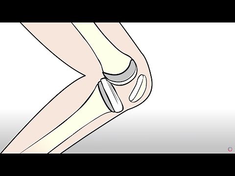 Knee Replacement vs. Regenexx Orthopedic Regenerative Treatment