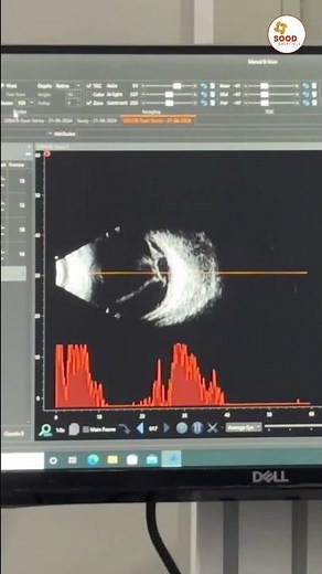 B-Scan Ultrasonography of the Eye