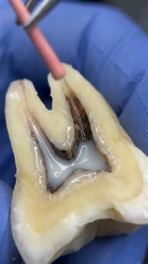 How a Root Canal Treatment Works Step by Step 🦷