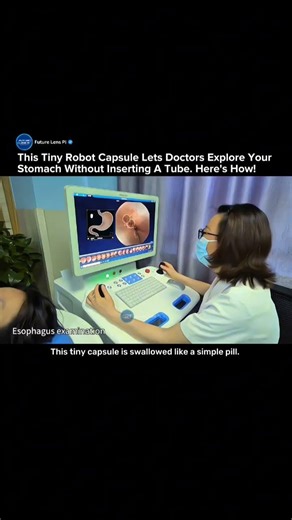 Swallowable Robot Camera Replaces Endoscopy Without Pain or Sedation #medical #roboticsurgery #tech