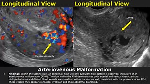 Postpartum Uterus Ultrasound Reporting | RPOC/Retained Placenta Scan Reports | Pelvic USG Intro - 0:00 Early Stage Postpartum Uterus - 0:10 2nd Week Postpartum Uterus - 1:55 Retained Placenta - 3:34 Retained Products Of Conception - 4:25 RPOC Gutenberg Classification - 5:34 Arteriovenous Malformation - 8:02 | Dr. Sam's Imaging Library