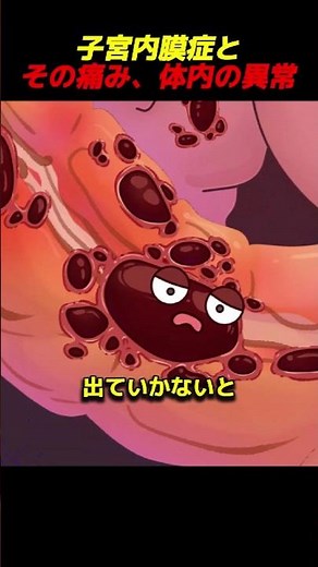子宮内膜症とその痛み、体内の異常