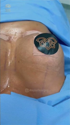 Life-Changing Breast Reduction + Lift🍒at Vive Plastic Surgery #tijuana 💖