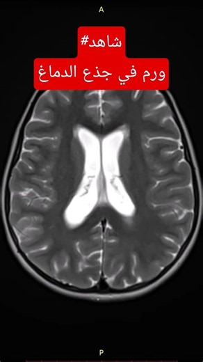 رنين الدماغ يكشف ورمًا دبقيًا (Glioma) بدقة عالية. #MRI #BrainMRI #Glioma #Radiology #رنين_مغناطيسي