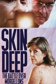 Skin Deep: The Battle Over Morgellons