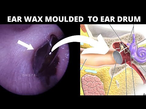 Black Ear Wax Moulded To Surface Of Eardrum