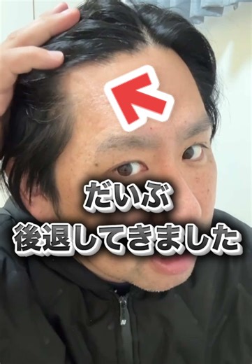 【髪増やす】ウワサのミノキシジルをTikTok Shopでゲットしてみました！ #ミノキシジル #AGA治療 #40代