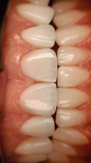 YOUTUBE TITLEDr. Zarifeh: Hollywood Smile Beirut, Prep-less Veneers & Digital Design Excellence