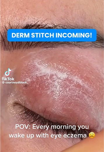 Understanding Eyelid Eczema and Its Treatments