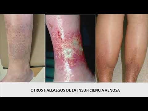 II Jornadas de Prevencion de Ulceras Por Presión (2 de 3). Mesa 1