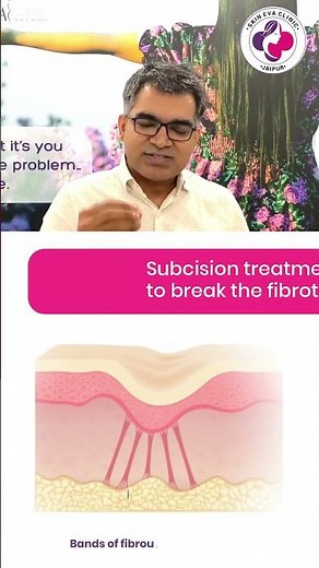 Subcision for Acne Scars | How It Works & Why It’s Effective | Dr. Sunil Kothiwala