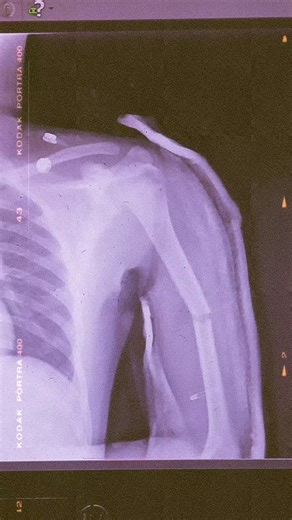 Midshaft Femur Fracture Midshaft Humerus fracture Orthopedics KTH 🥰 #orthopedics #traumahealing #traumahealing #surgeon #medical #bones | Muhammad Noor Wazir