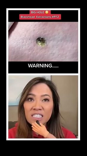 Dr Pimple Popper Reacts to Blackhead Extraction! #shorts #drpimplepopper