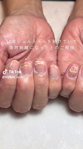 爪甲剥離の原因とケア方法｜滋賀自爪育成サロン
