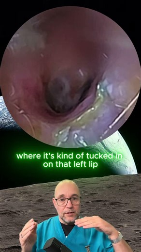 HUGE ear canal CHOLESTEATOMA! full video in link below