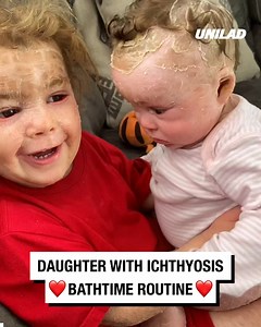 Bathtime routine for our daughter who has ichthyosis ❤️ | UNILAD