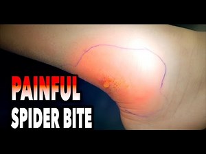 PAINFUL SPIDER BITE! | Dr. Paul