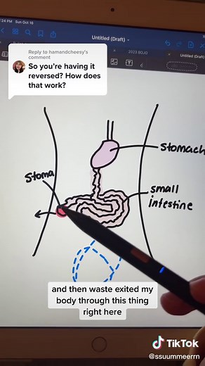 Replying to @hamandcheesy #ostomy #ostomyawareness #endstomastigma #loopileostomy #jpouch #jpouchsurgery