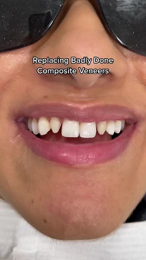 Dr Danya replacing existing composite veneers to restore the original peg shaped teeth & overall transform the smile. In total 10 teeth have been treated 😍