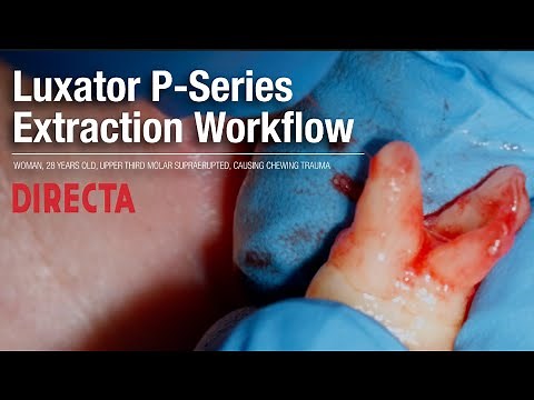 Luxator Extraction | Start To Finish