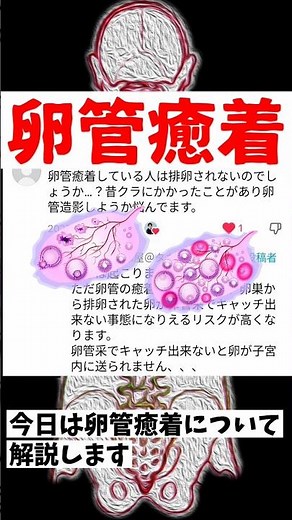【卵管癒着】で《排卵しない？》#卵管摘出 #卵巣チョコレート嚢胞 #卵巣摘出 #卵管捻転