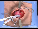 Inguinal Hernia Surgery 3D Medical Animation - Open Procedure • Video • MEDtube.net