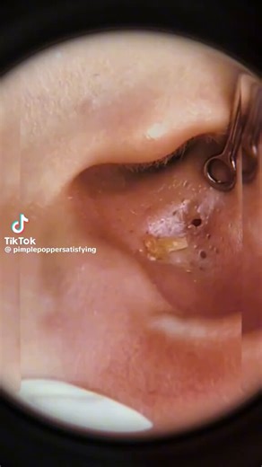 Removing blackheads from the ear can be very difficult but it's actually satisfying to watch btw.😱😱😱