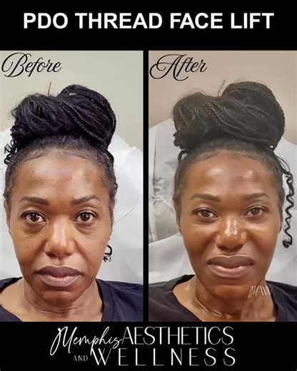 4 comments | ✨ PDO THREAD FACE LIFT ✨ Cheeks lifted. Jawline...
