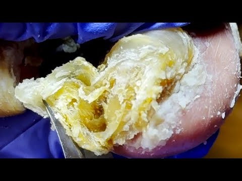 Extra Long Curly Onychomycosis, Remove Dead Skin!【Xue Yidao】